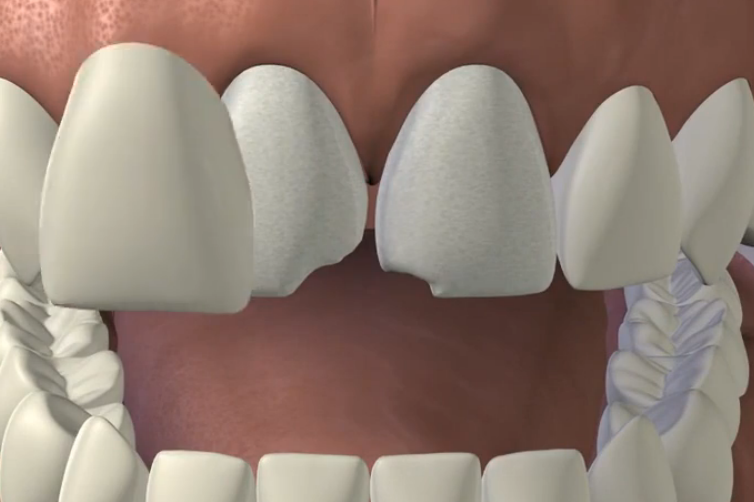 Porcelain Veneers